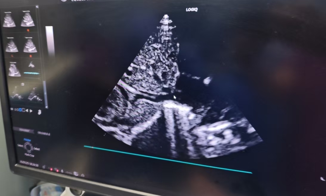 为1540克早产宝宝打通 “生命之桥”！我院首例新生儿PICC置管成功